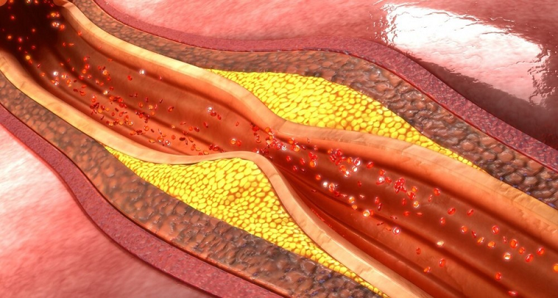 【健康科普】血压居高不下&mdash;&mdash;可能是肾动脉&ldquo;堵&rdquo;了！