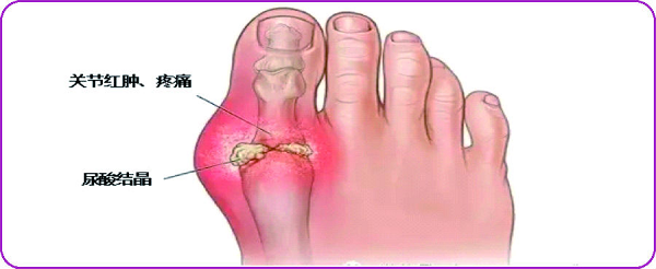 &ldquo;三比三争&rdquo;践行动 | 走出误区，回归科学&mdash;&ldquo;世界痛风日&rdquo;义诊活动来啦！