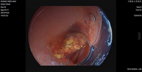 不开刀，保阑尾&mdash;&mdash;阑尾炎经肛门超级微创手术