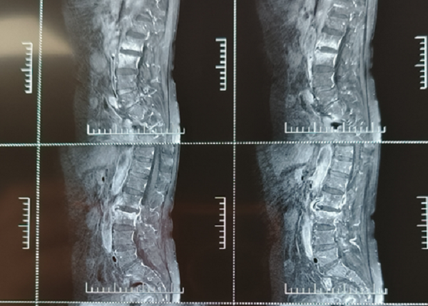 微创治疗老年脊柱结核，新技术为健康加&ldquo;骨&rdquo;劲