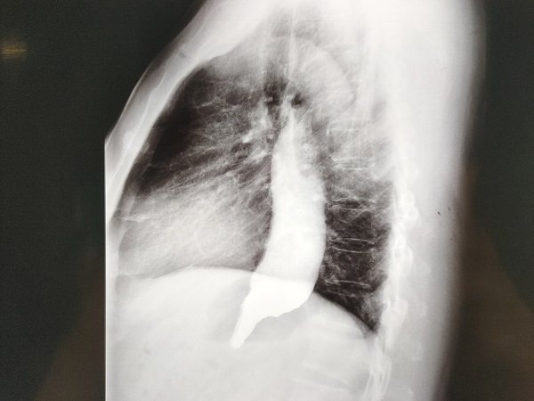 打通经口进食的&ldquo;生命隧道&rdquo;！我院成功开展腹腔镜下食管贲门肌层切开术