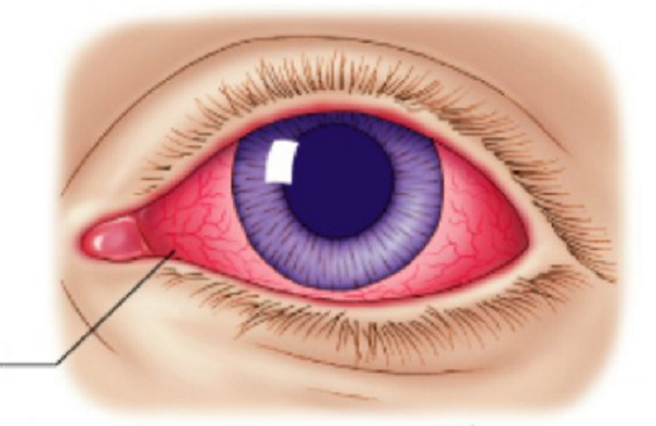 &ldquo;看&rdquo;红眼病患者一眼，会得红眼病吗？