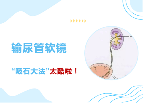 泌尿外科超强绝技上线-输尿管软镜下的&ldquo;吸石大法&rdquo;