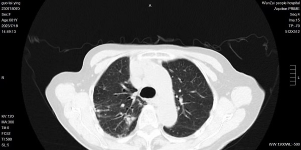 【健康科普】关于非结核分枝杆菌（NTM），您知多少？