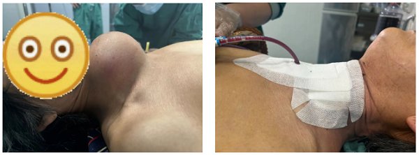 50年痛苦一朝解除&mdash;&mdash;我院甲状腺外科成功实施一例巨大甲状腺肿物手术