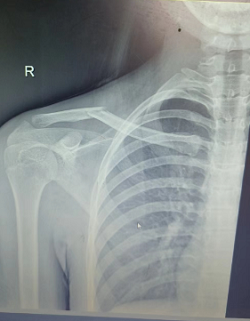 微创治疗锁骨骨折，让您拥有漂亮的&ldquo;美人骨&rdquo;！