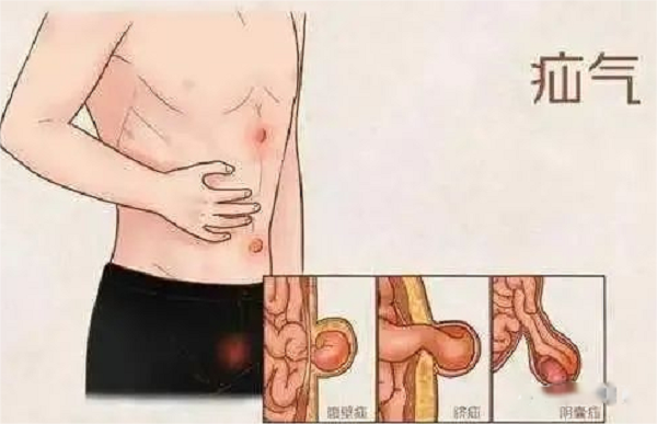 [义诊预告]&ldquo;疝气&rdquo;患者福音！3月7日&ldquo;中国疝气宣传日&rdquo;大型免费义诊活动重磅来袭！