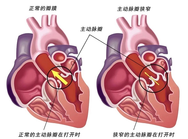 突破性进展！我院成功完成首例经导管主动脉瓣置换术（TAVR）