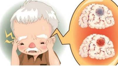 缺血性脑卒中溶栓黄金4.5小时，你知道怎么抓住吗？